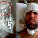 vite nel cranio incidente