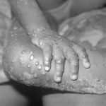 Il vaiolo delle scimmie colpisce di nuovo: contagio, sintomi e cure