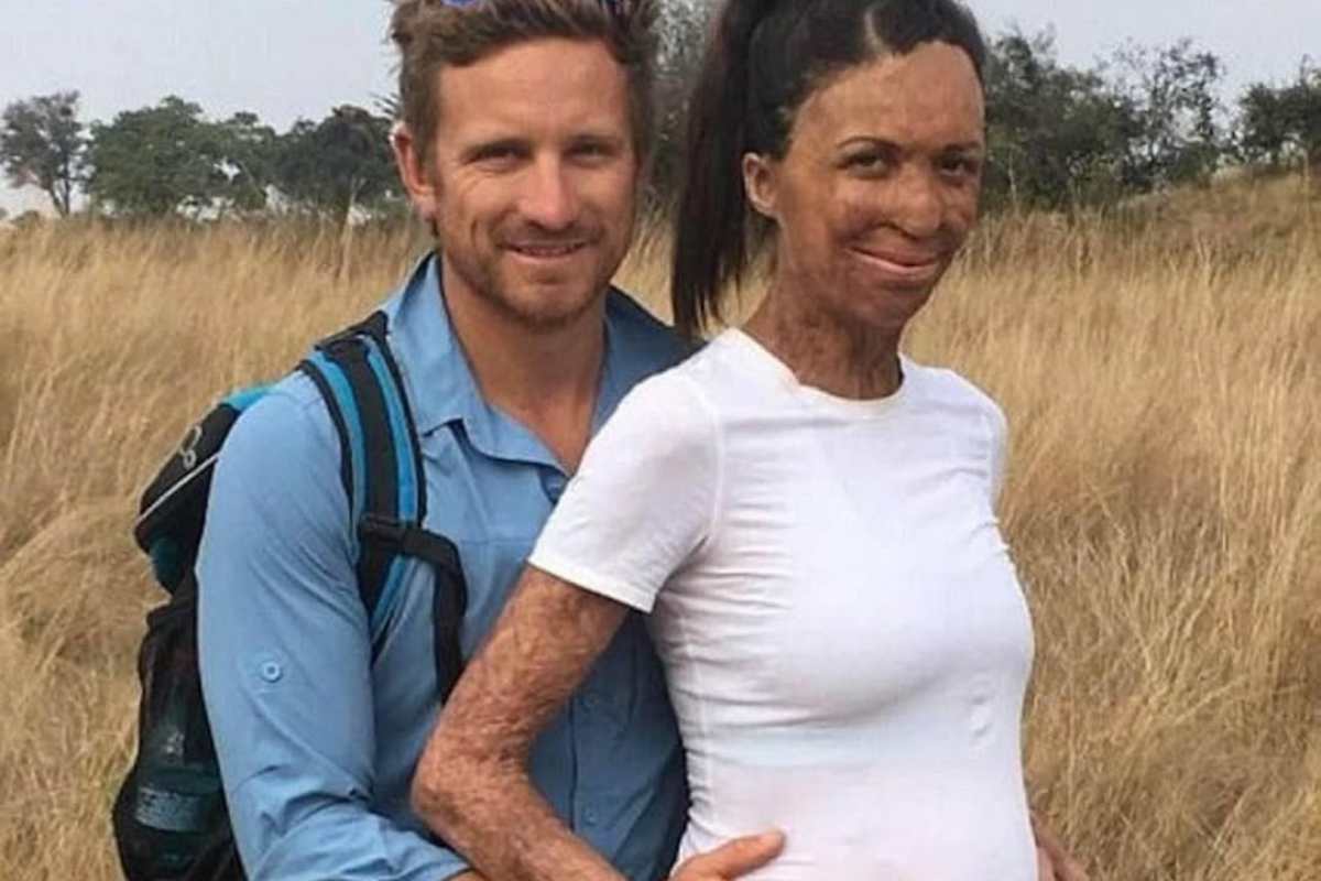 Turia Pitt, il tremendo incidente durante un’ultramaratona e l’amore che (a volte) trionfa su tutto